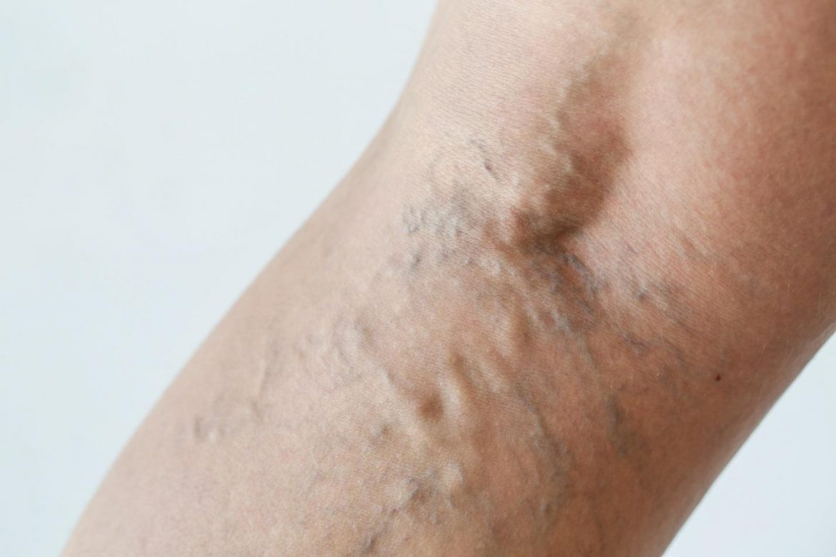 Varicose Vein Treatment